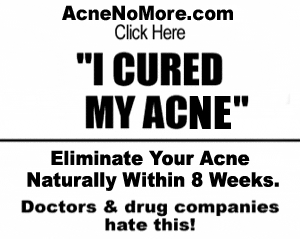 Acne No More